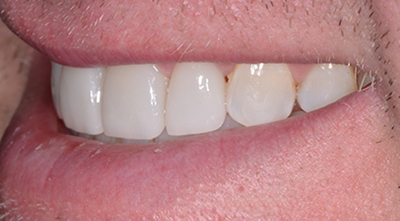 Dental Filling After