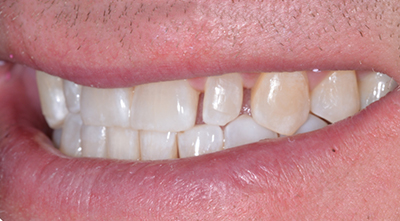 Dental Filling Before