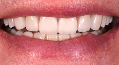 All in X Dental Implants After