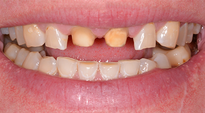 All in X Dental Implants Before