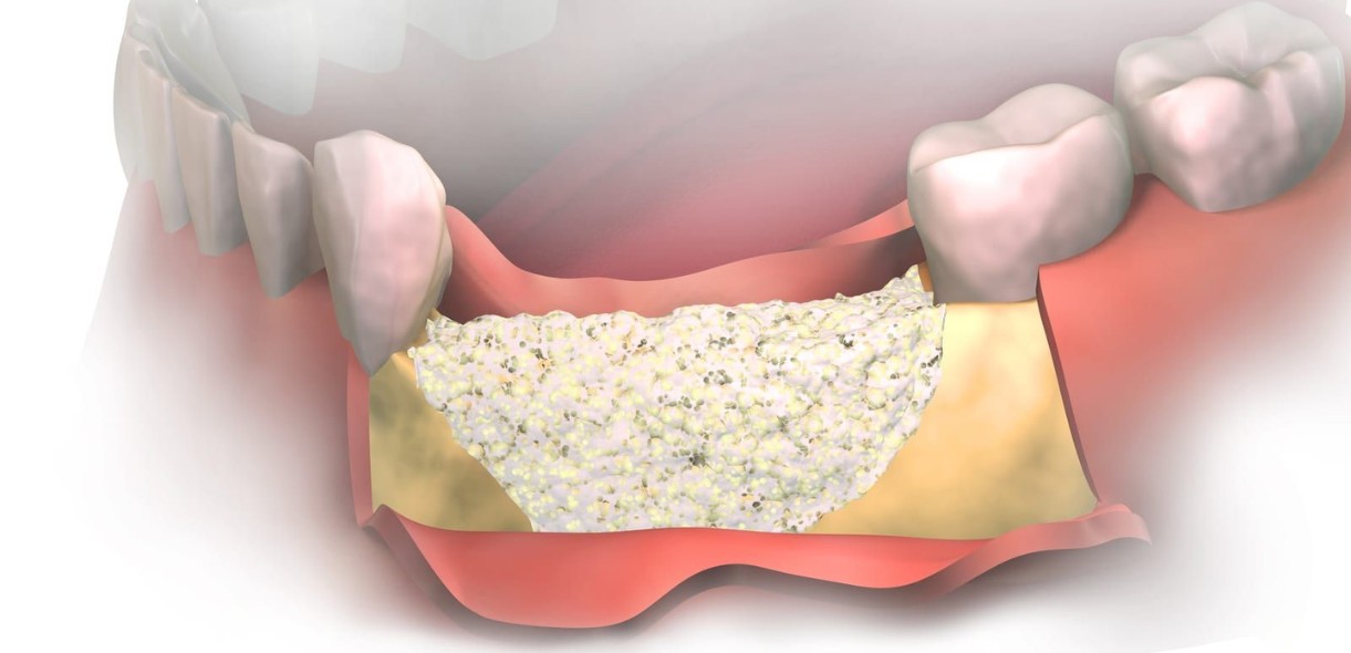 Understanding Bone Graft Healing - Jamaica Plain Dental