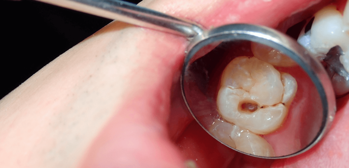 How to Find and Treat a Cavity Between Two Teeth