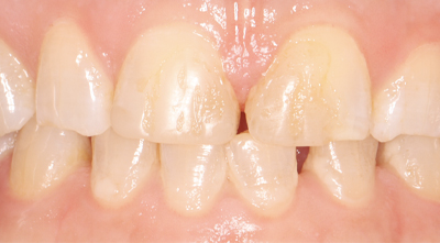 Dental Veneers Before