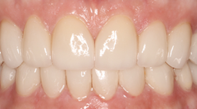 Dental Veneers After