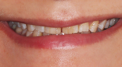 Dental treatment Before