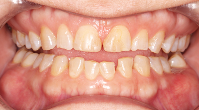 Dental treatment Before