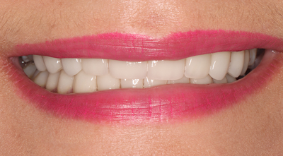 Teeth Whitening After