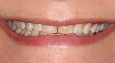 Teeth Whitening Before