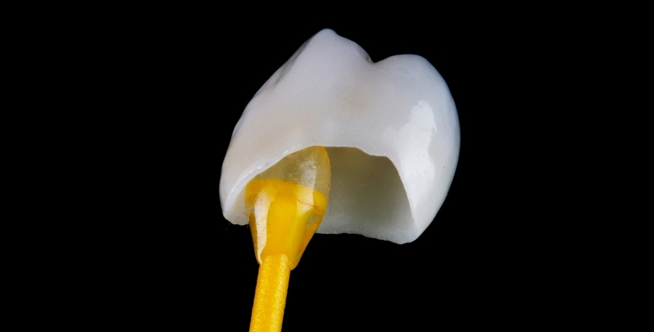 how long dental crowns last
