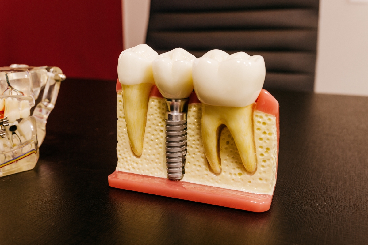 dental implants in Jamaica Plain