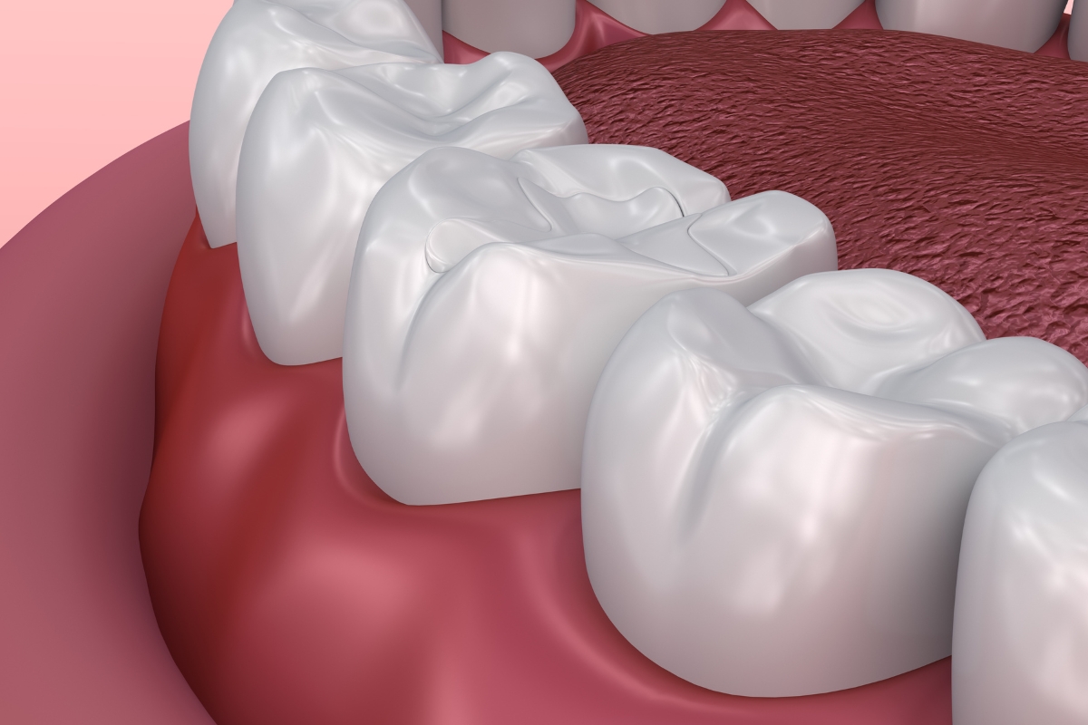 dental-Sealants-In-Jamaica-Plain