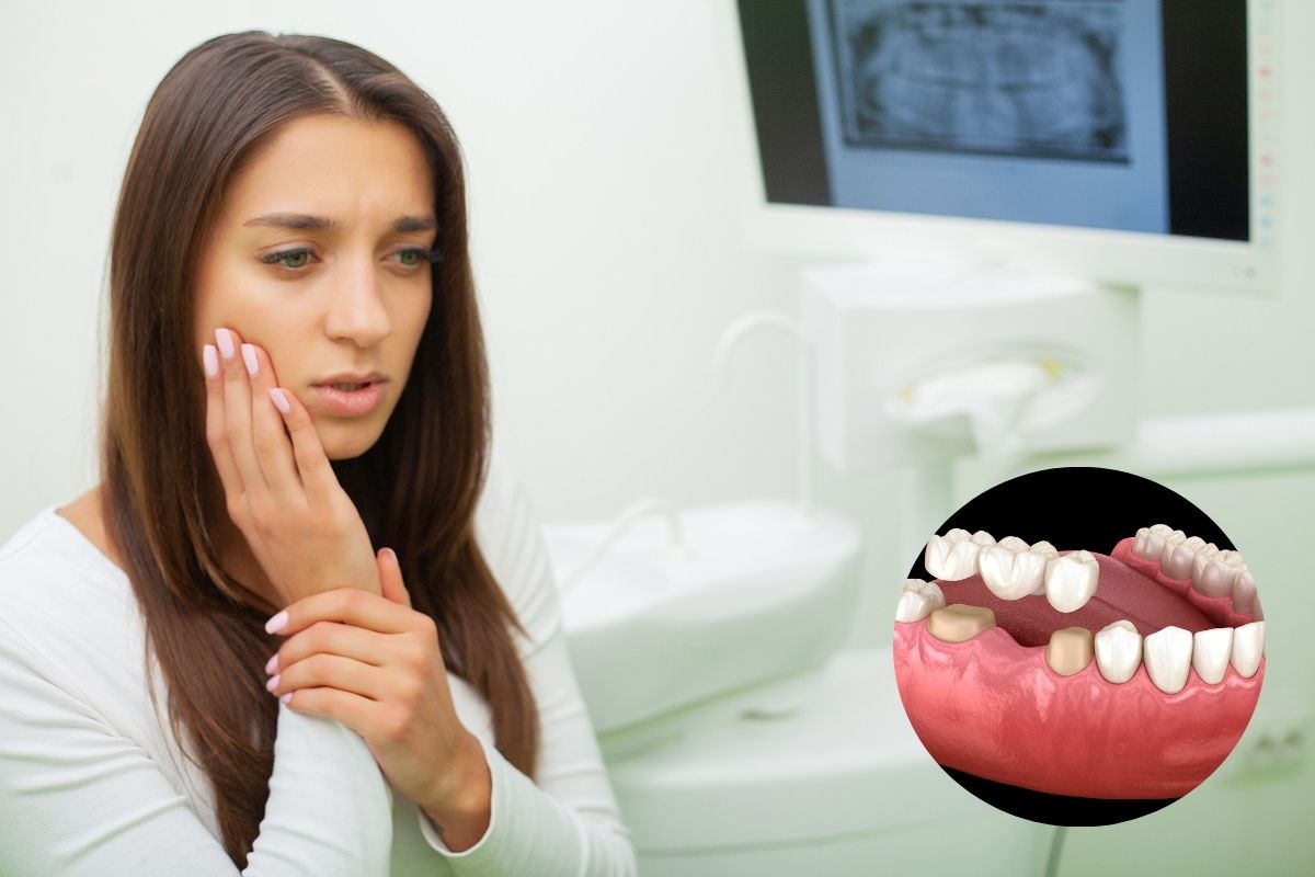 Dental Bridge Falls Out