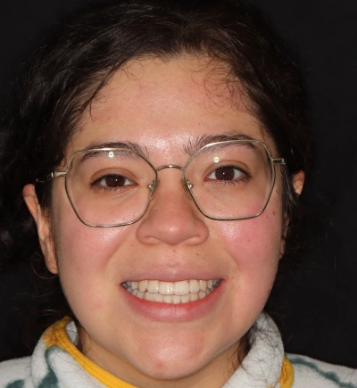 Dental Veneers After