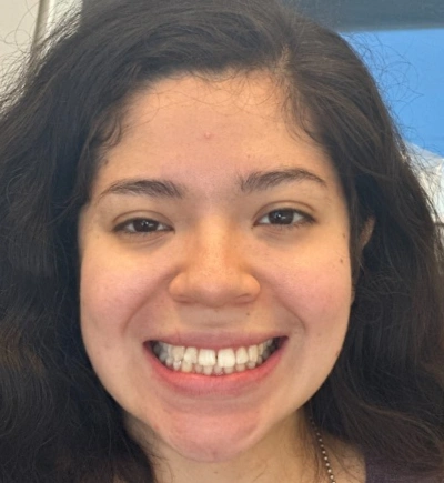 Dental Veneers Before