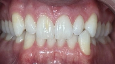 Dental Veneers Before