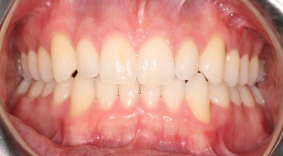 Dental Veneers After