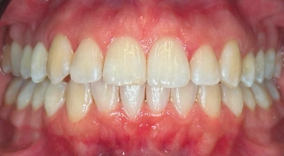 Dental Veneers After