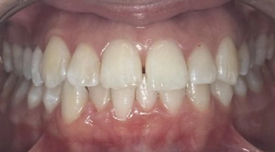 Dental Veneers Before